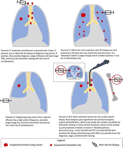 Lung Biopsy: Types, Results, and Risks .